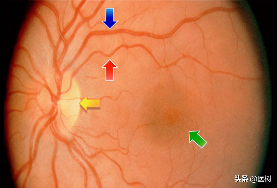 绿色箭头:黄斑和中央凹,为视觉最敏锐的地方,反而血管最小,最少!