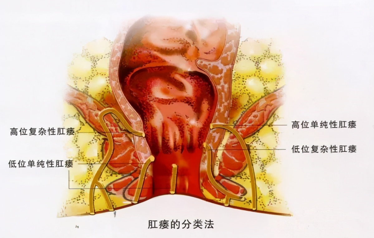 肛肠科患者与医生的真实对话，还原肛瘘的真相，让你不走弯路