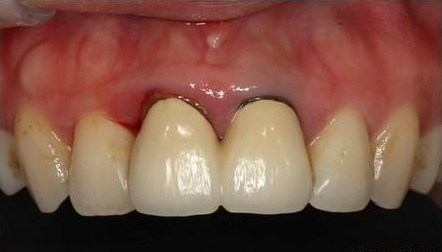 有的人,由于日常刷牙习惯的问题或是有牙周病牙造成牙肉萎缩现象,牙肉