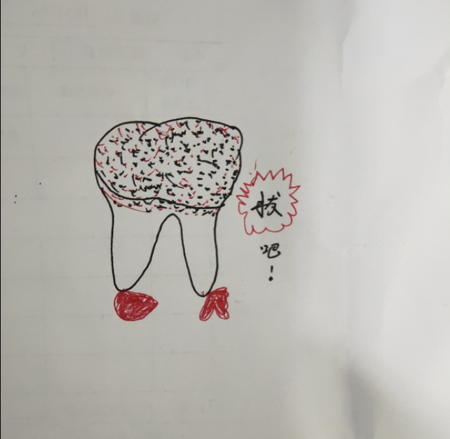 口腔医生耐心画图为你解答｜牙齿龋病的正规治疗方式