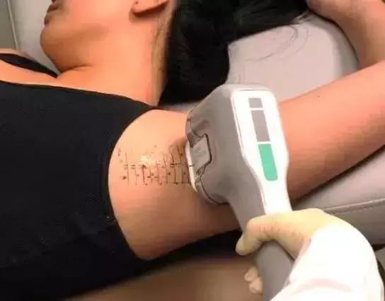 腋臭治疗过程大揭秘，有图有真相