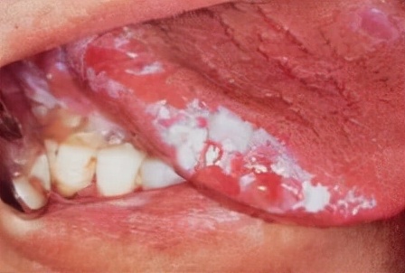 舌头出现这9个症状,暗示身体有问题