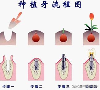 种植牙知识全面解答