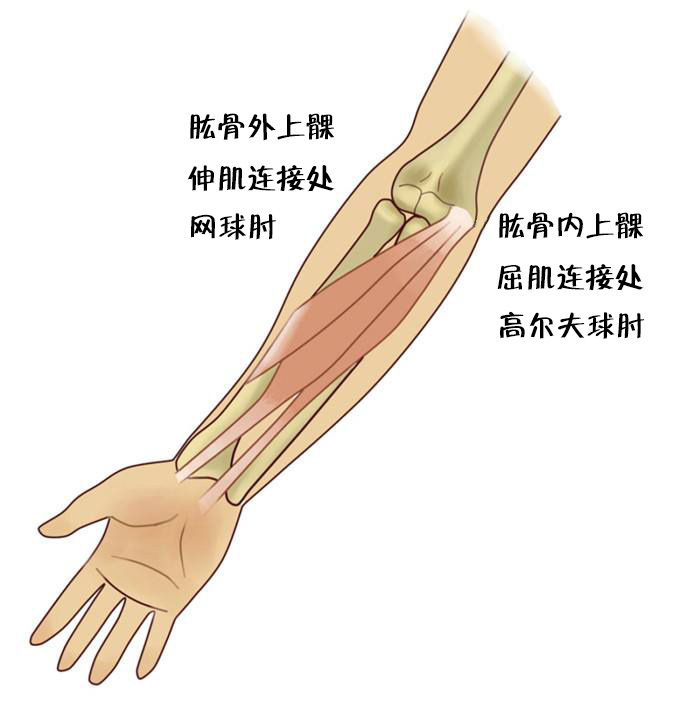 ,是肘关节外侧前臂伸肌起点处肌腱发炎疼痛,又可