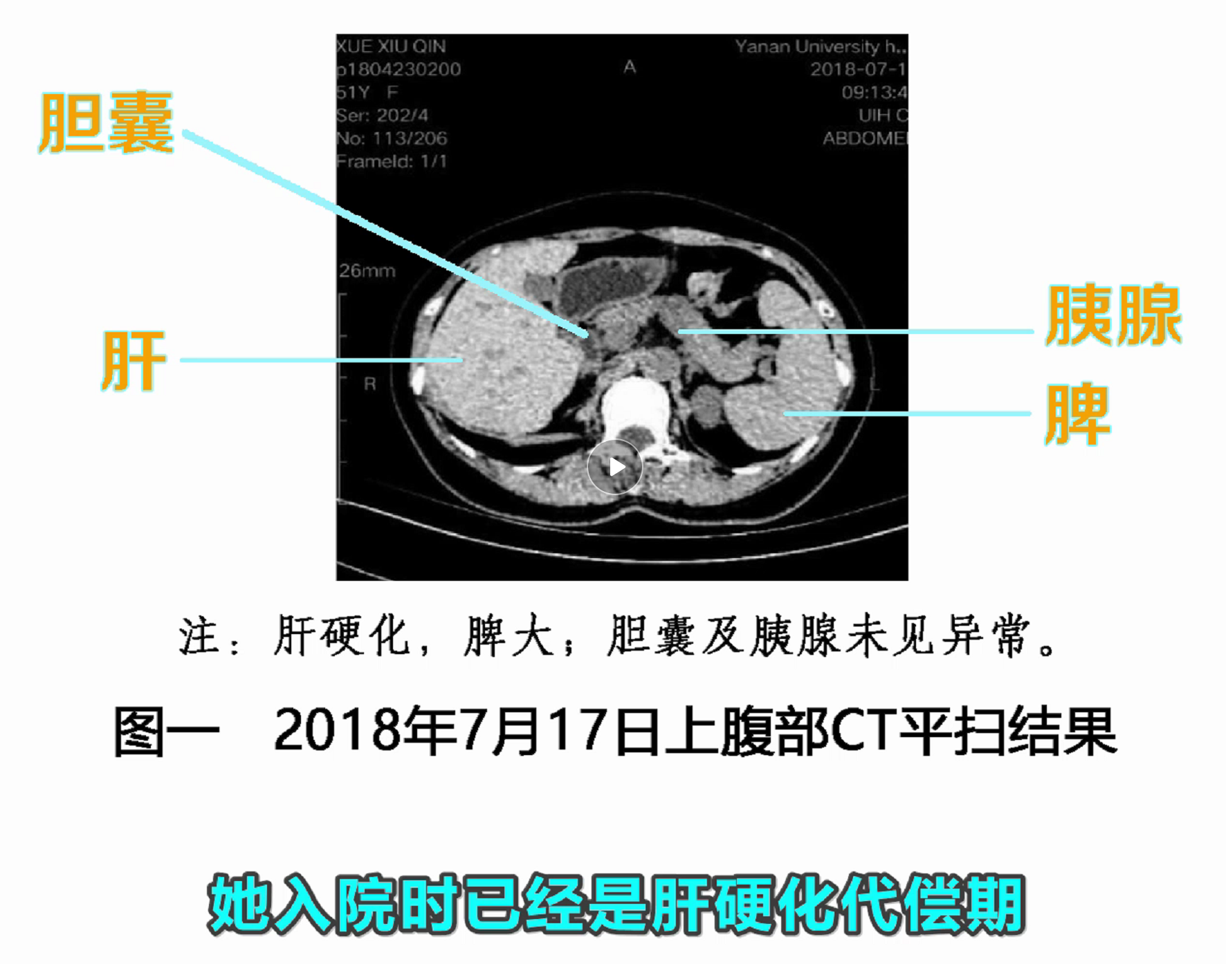 干扰素，逆转1例乙肝肝硬化的病人，为什么它却得不到全面应用？