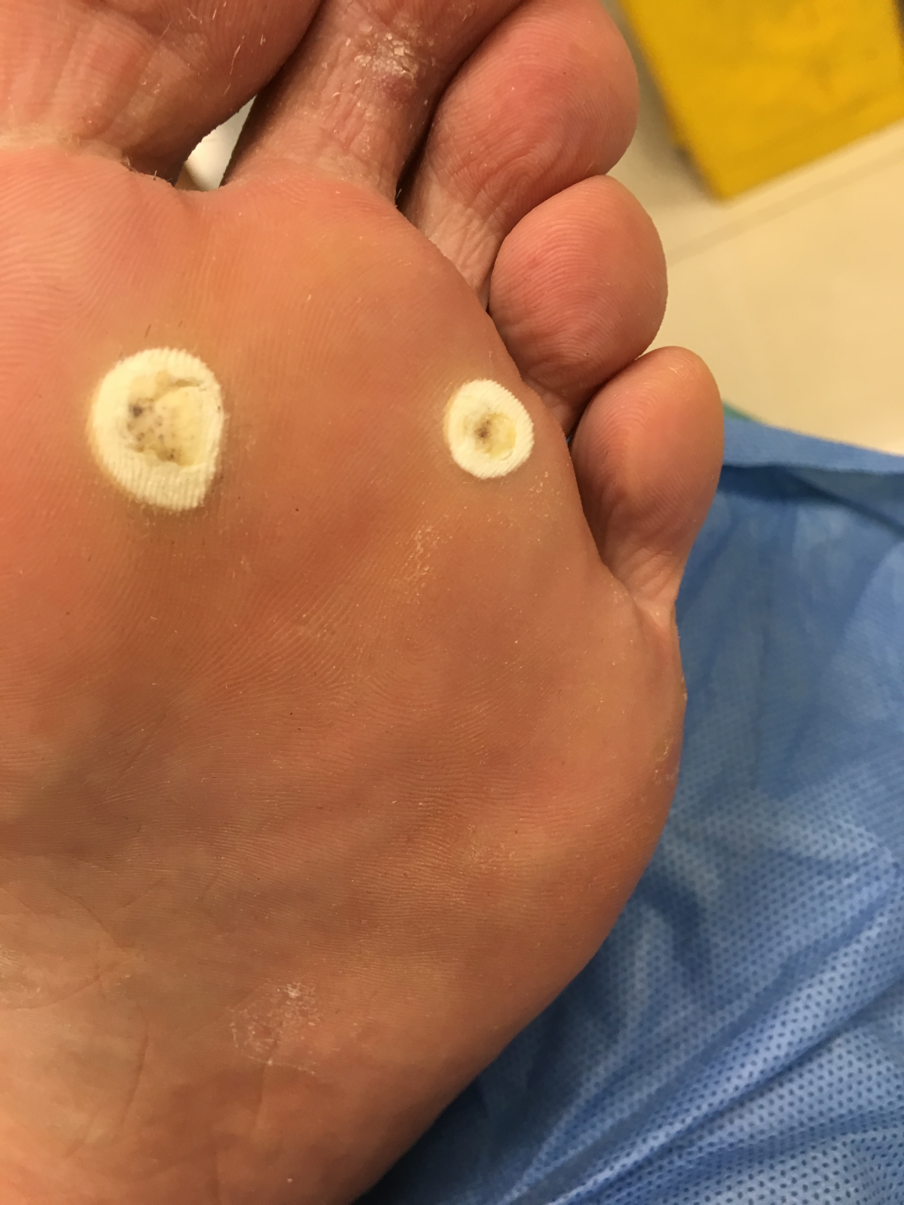 脚上长的是鸡眼,瘊子,还是老茧,你搞清楚了吗?