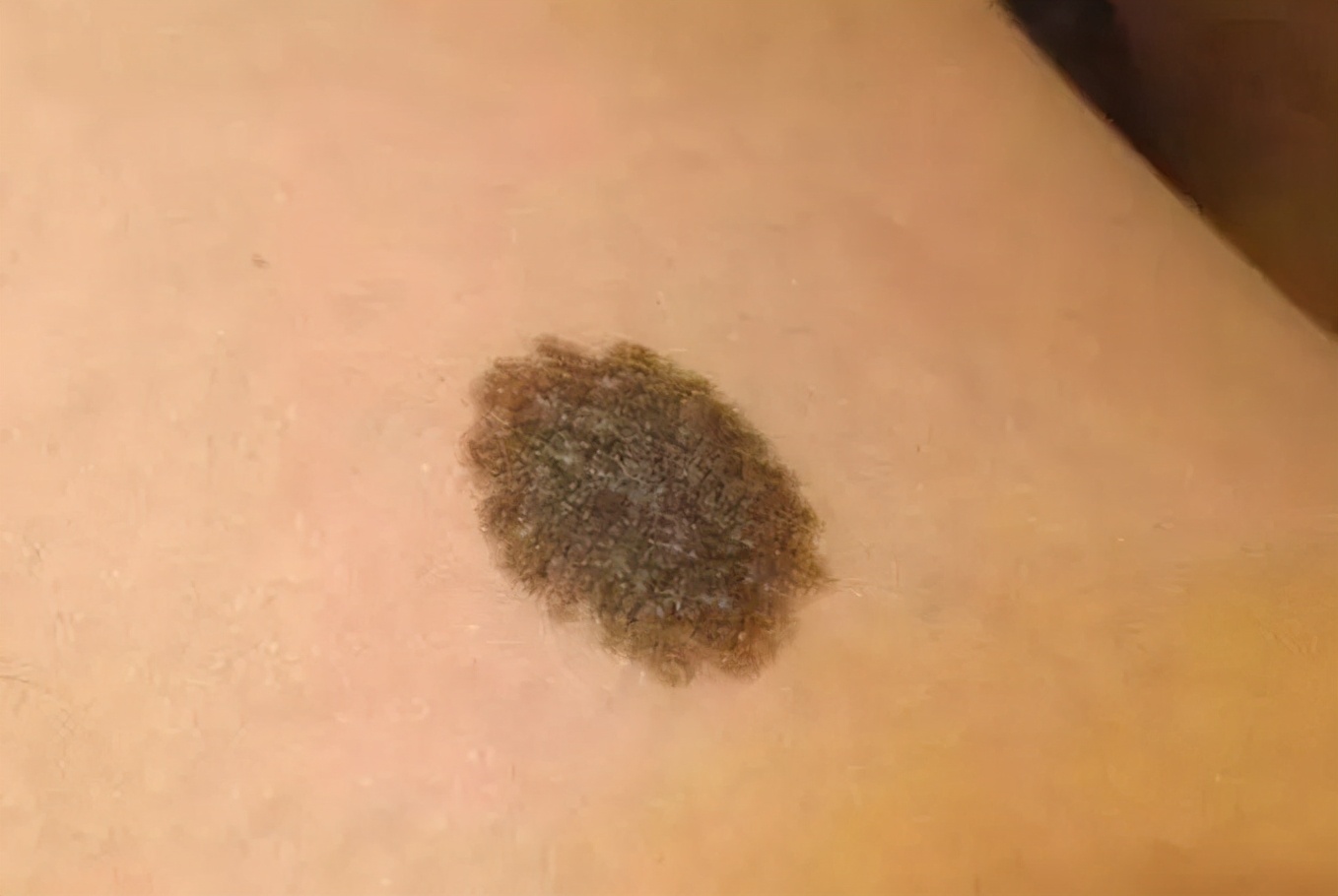 1,咖啡牛奶斑这是一种浅褐色斑,能发生在身体的任何部位,而且是永久性