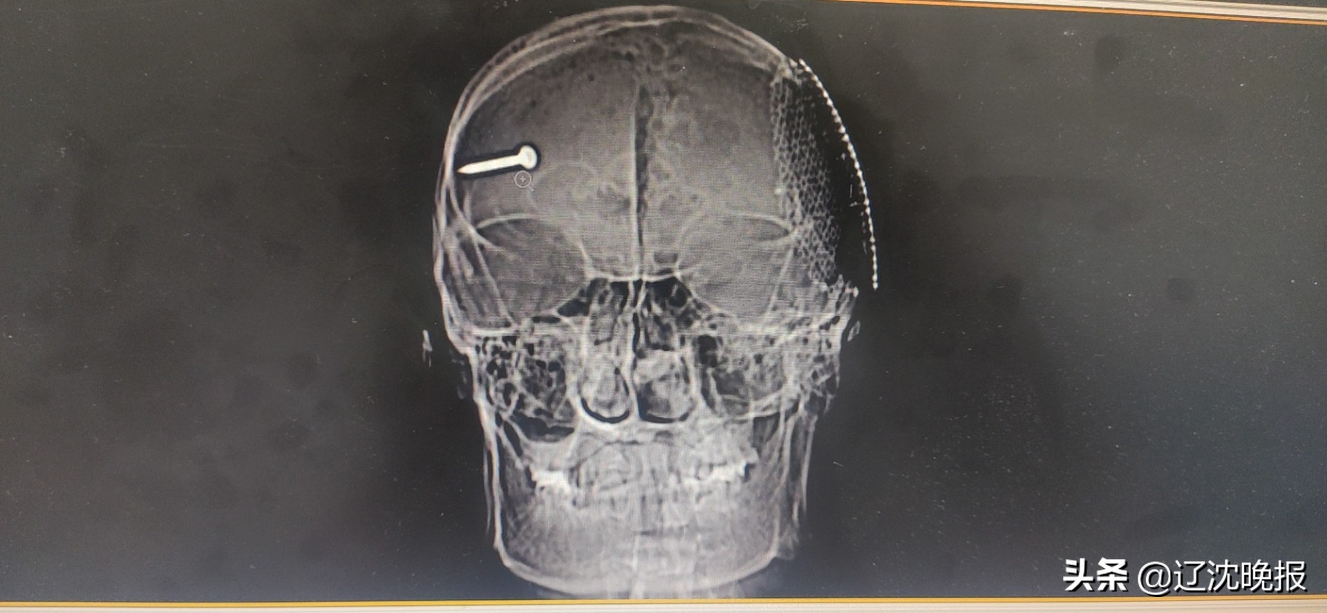 钢钉反弹伤人！3.5厘米长钢钉在大脑内穿行8.8厘米，伤者仍未完全脱离生命危险…