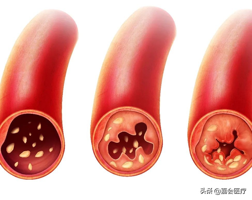 头晕、头痛、腿酸胀…可能是血管悄悄地出了问题