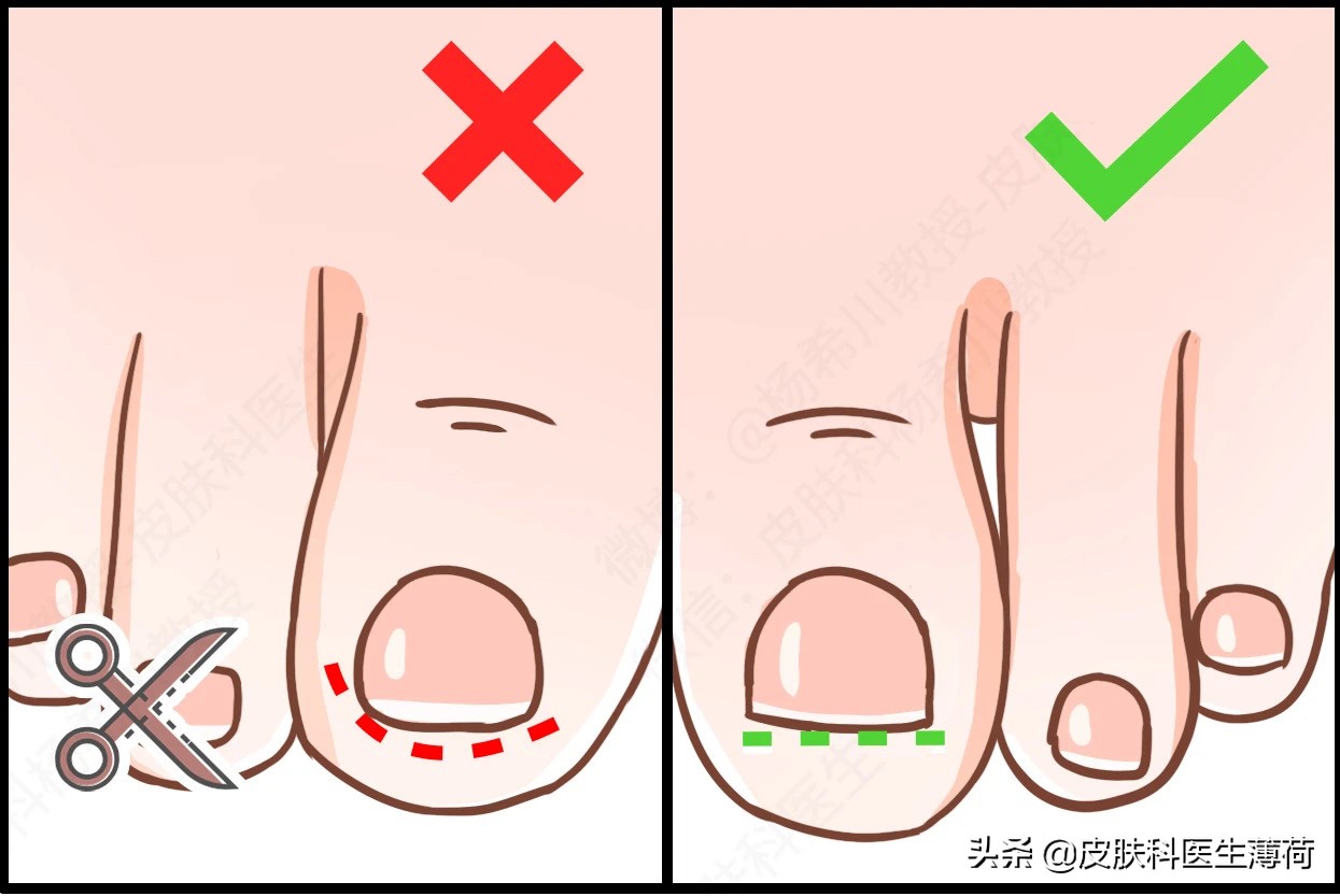 90%的人都剪错指甲啦