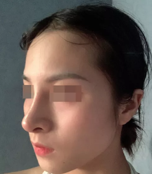 韦敏科普丨为什么假体隆鼻,高度不能随心所欲?