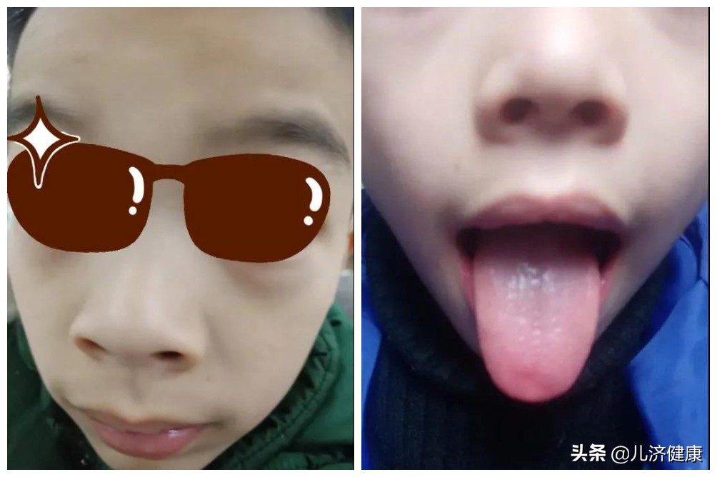 许尤佳教授：儿童脾胃虚寒调理指南与案例
