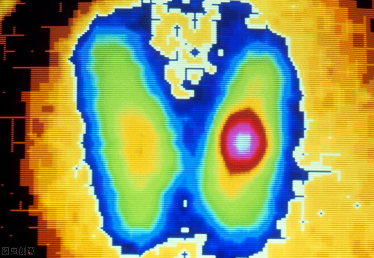 甲亢的详细介绍，治疗方案来了，请收藏