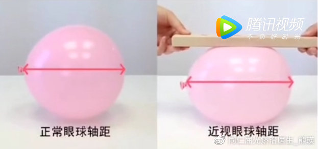 除了近视手术，哪些方法可以让真性近视恢复视力？