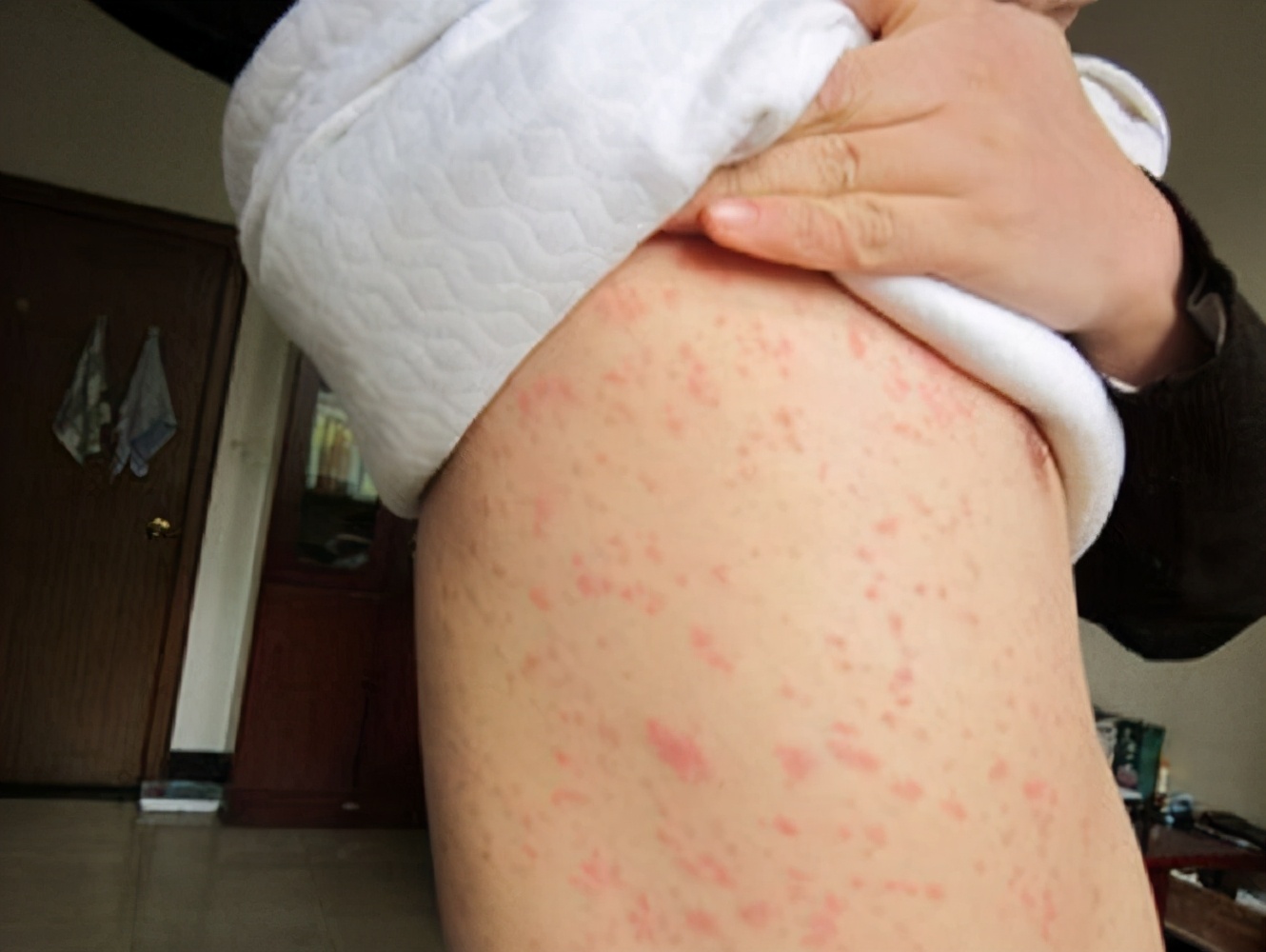 ︱胃肠道疾病还会出现哪些"皮肤病"?