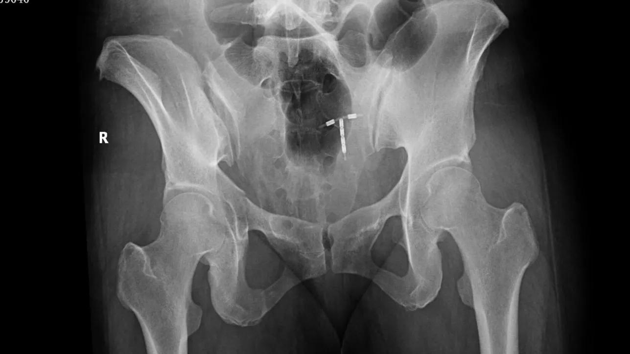 X线片已经确诊骨折了，为什么还要做CT三维重建？