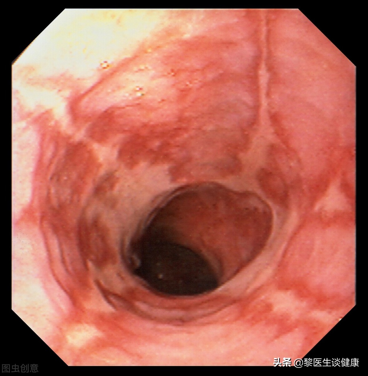 胸痛为何查胃镜？医生带你了解反流性食管炎如何发生？有何症状？