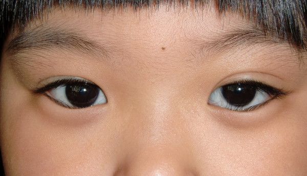 先天性大睑裂倒睫毛新生儿泪囊炎外斜视内斜视白瞳症睑裂大小随面部