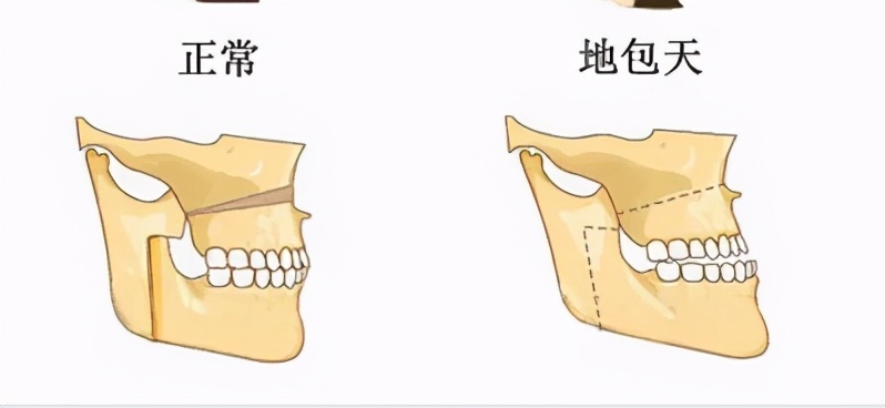 01地包天怎么形成的?