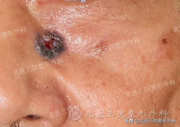 聊一聊：你熟悉的“痦子”