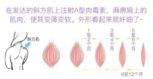 注射瘦肩针不知道这3点，千万别打