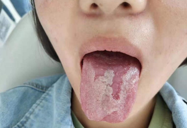 8岁儿童舌头出现“花”样，是不是肿瘤？勿慌，一般可自愈