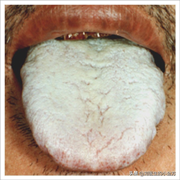 《中医舌诊》,26张临床高清舌诊图,附带解析,史上最全!