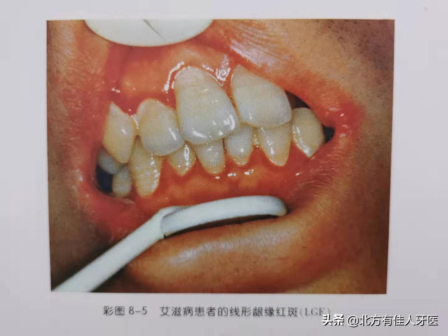 有类似症状的边缘线龈炎的充血是由菌斑和牙石引起,所以要看口腔卫生