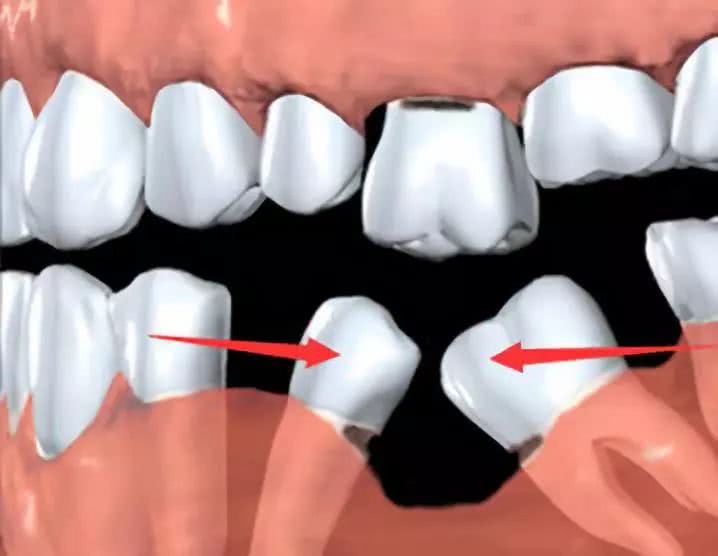 牙齿松了还能恢复吗？如何固齿？日常做到这6点，牙齿还保得住