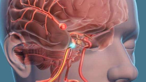脑动脉瘤不是“肿瘤”，却为何比肿瘤更可怕？
