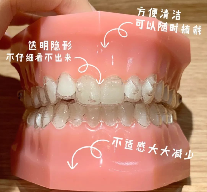 凸牙齿矫正外观图片_牙齿外凸矫正_矫正牙齿牙齿外突