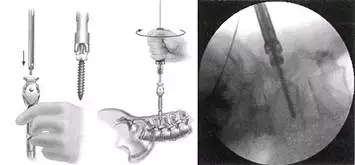 SEXTANT Ⅱ经皮椎弓根螺钉系统