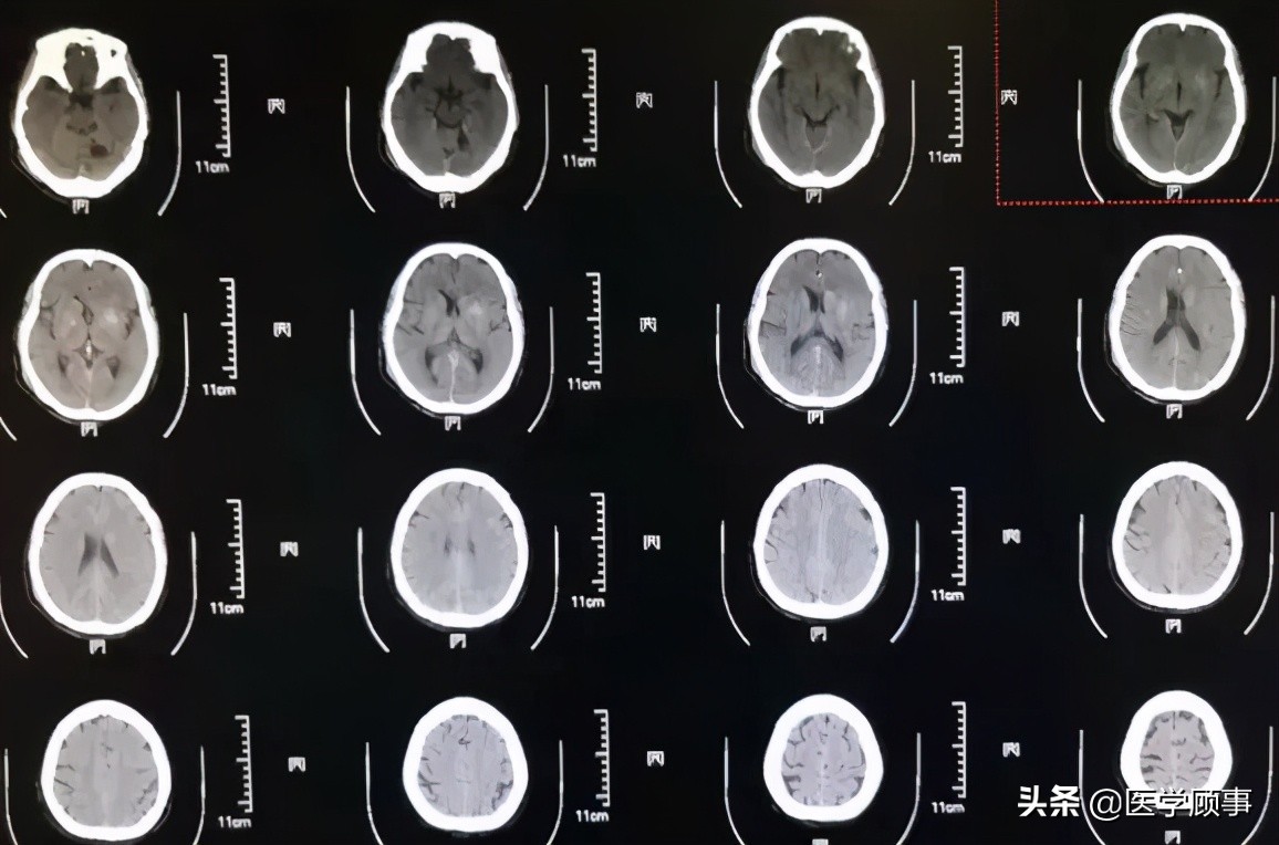 血管内取栓治疗超时间窗的左侧大脑中动脉闭塞