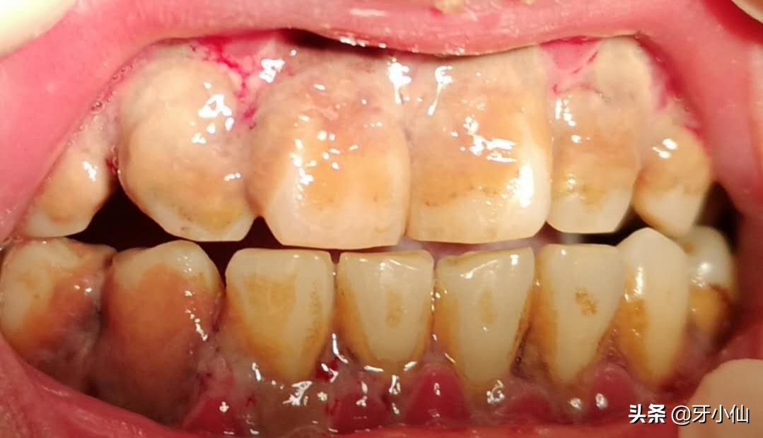 牙龈红肿出血只是上火?人老就掉牙?预防牙周病,让牙齿相伴终生