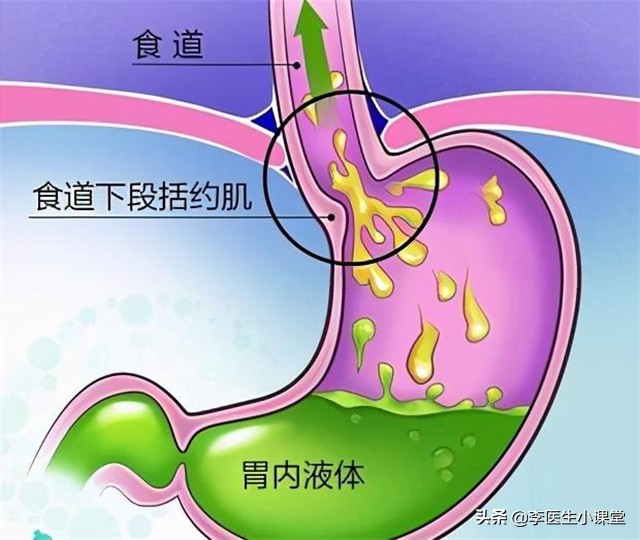 总是反酸烧心？教你有效缓解胃酸倒流的方法