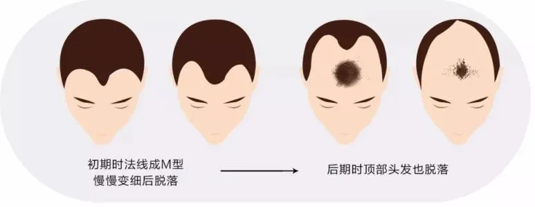 植发太贵,雷军吐槽“每个人头顶着一栋别墅”,植发经济了解下?