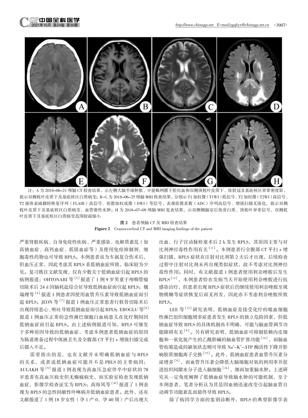 车祸复合伤并低钠血症致可逆性后部白质脑病综合征报道并文献复习