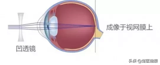 公立医院眼科医生揭秘：近视激光手术到底靠不靠谱