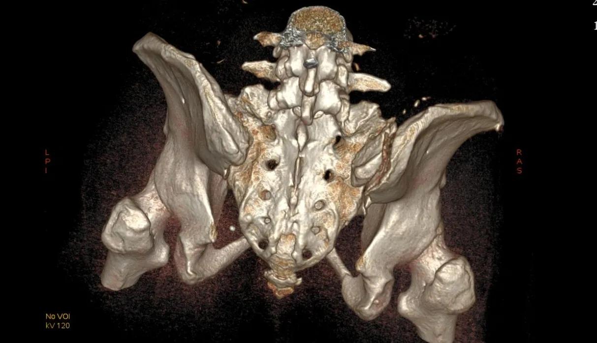 X线片已经确诊骨折了，为什么还要做CT三维重建？