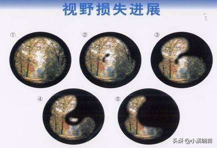 警惕青光眼的五种早期信号