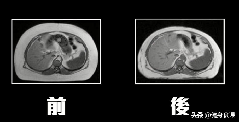 为什么抽脂手术能够减肥？但是这2个方法，减肥更有效更省钱