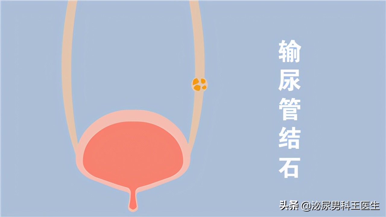 你了解过坦索罗辛吗？除了改善尿频，还能治疗3种常见的男科疾病
