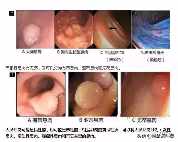 肠镜发现肠息肉怎么办？消化科医生：有的必须切，有的不用切