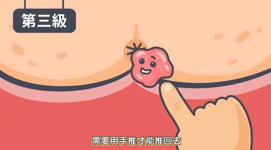 便秘+痔疮,千万别自行用药,当心越用越糟