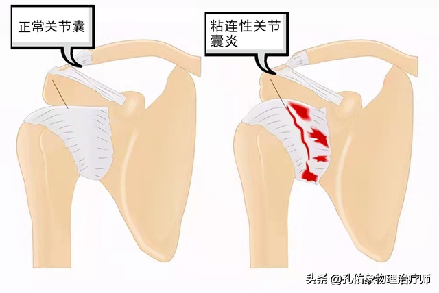 肩周炎是导致肩痛的原因，结果大家都进入误区，咋不想想其他病因