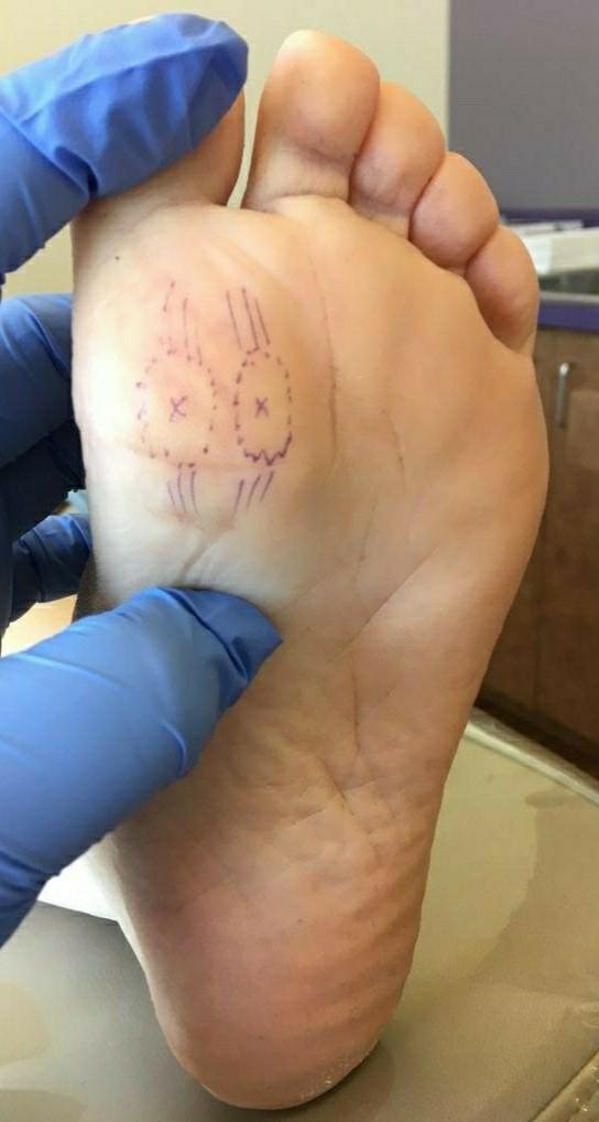 它由第一跖骨(有两个籽骨的关节),第一近节指骨和第一远节指骨组成.