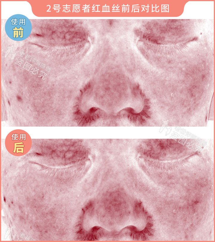 网红家用美容仪真的有效吗？2个多月的跟踪实测结果来了