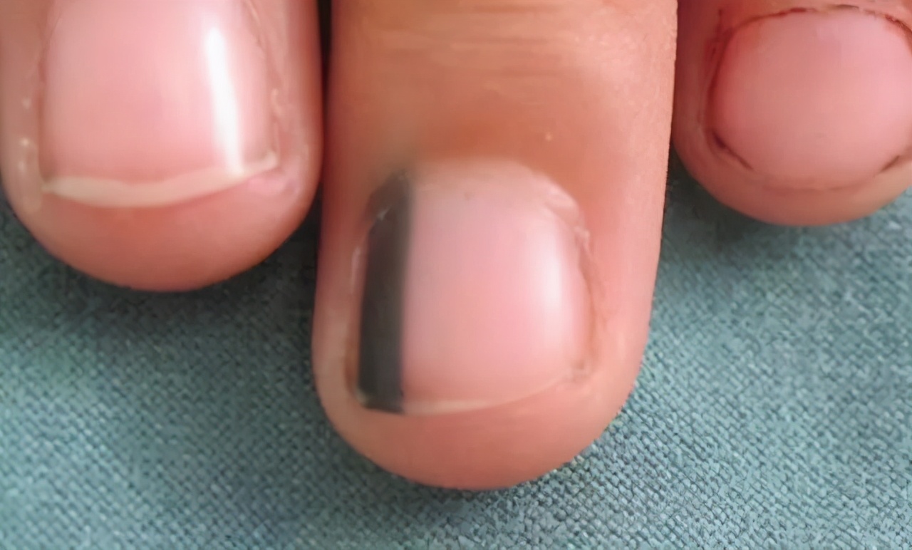看指甲能看出癌症?有这一类指甲的人要重视,小心发生癌变