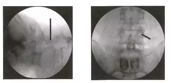 SEXTANT Ⅱ经皮椎弓根螺钉系统