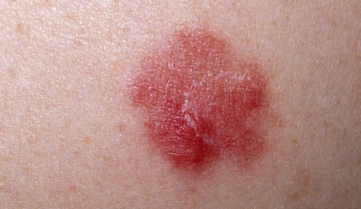 梅毒红斑初期症状图片图片